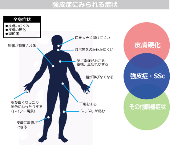 強皮症の症状