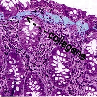 膠原線維(コラーゲン線維)