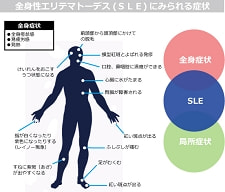 全身性エリテマトーデス（ＳＬＥ）の症状図
