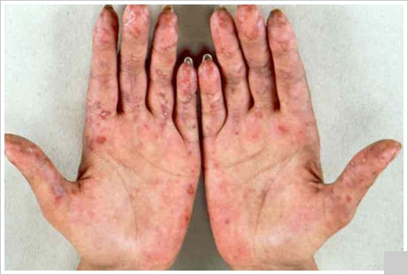 膠原病の症状 皮膚疾患 紅斑