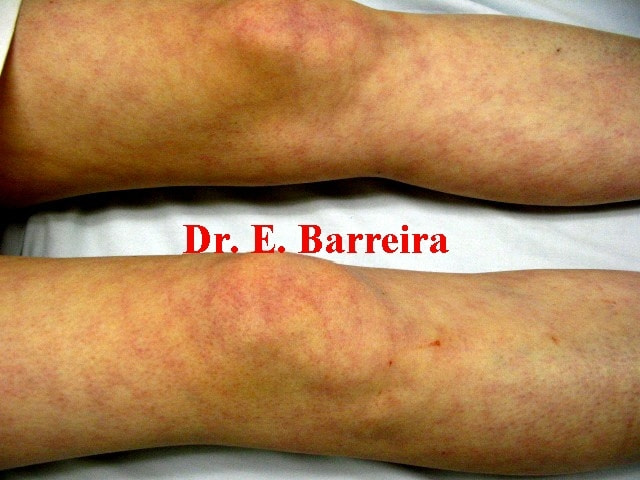 膠原病の症状 皮膚疾患 紅斑