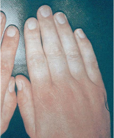 膠原病の症状 レイノー現象 皮膚の硬化 膠原病の症状 レイノー現象 皮膚の硬化