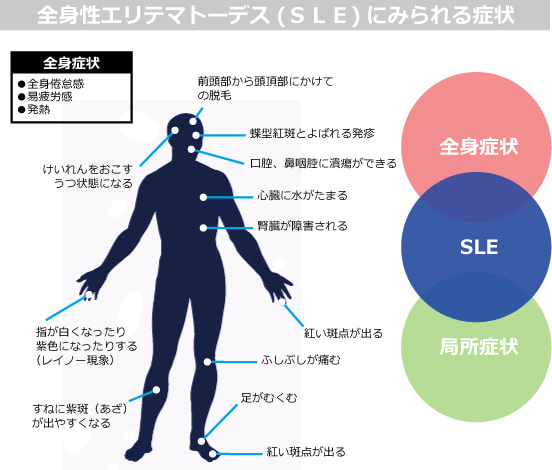 全身性エリテマトーデス（ＳＬＥ）の症状図