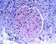 抗リン脂質抗体