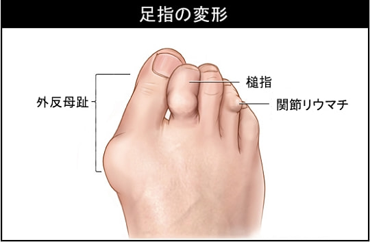足指の変形