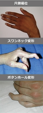 関節リウマチの手指の症状写真