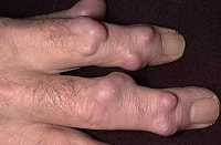 リウマトイド結節写真