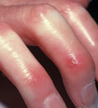 強皮症手指写真