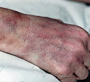 結節性多発動脈炎写真