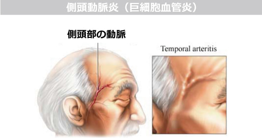 側頭動脈炎(巨細胞血管炎)