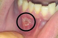 ベーチェット病・口内の潰瘍